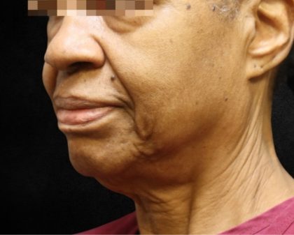 Fat Transfer Before & After Patient #12069