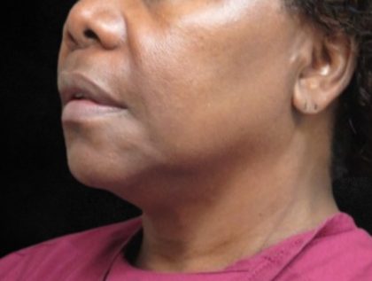 Fat Transfer Before & After Patient #12070