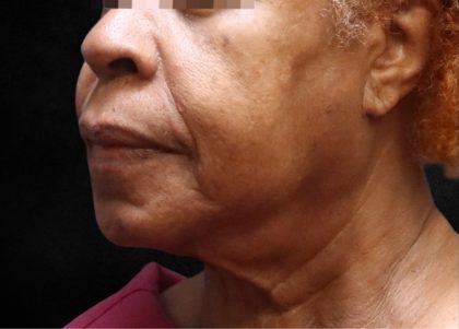 Fat Transfer Before & After Patient #12071