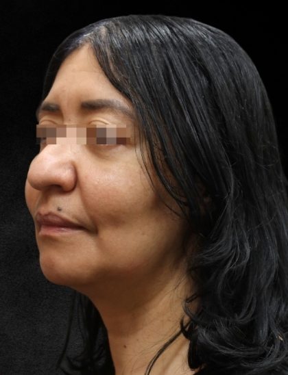Fat Transfer Before & After Patient #12064