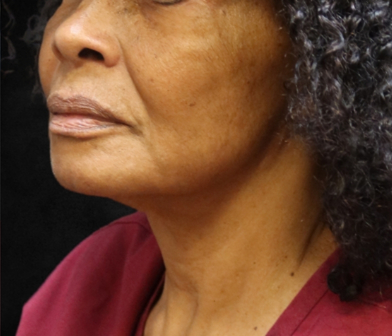 Fat Transfer Before & After Patient #12068