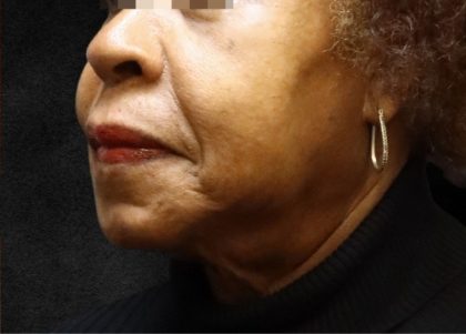 Fat Transfer Before & After Patient #12071