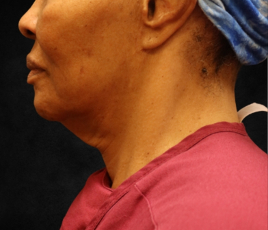 Fat Transfer Before & After Patient #12068