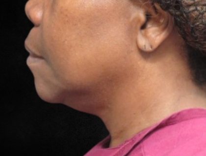 Fat Transfer Before & After Patient #12070