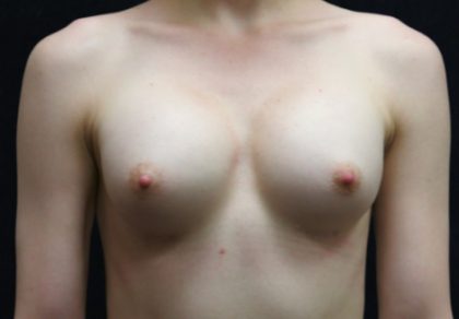 Breast Revision Before & After Patient #12249