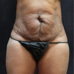 Revision Body Contouring Before & After Patient #12289