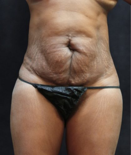 Revision Body Contouring Before & After Patient #12289