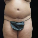 Revision Body Contouring Before & After Patient #12290