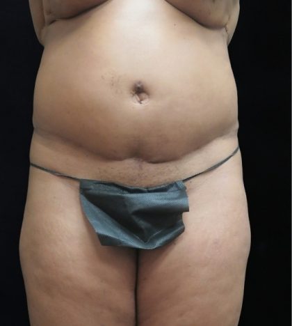 Revision Body Contouring Before & After Patient #12290