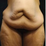 Revision Body Contouring Before & After Patient #12292