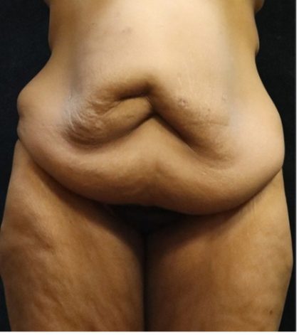 Revision Body Contouring Before & After Patient #12292