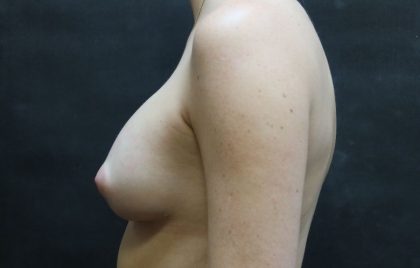 Breast Revision Before & After Patient #12251