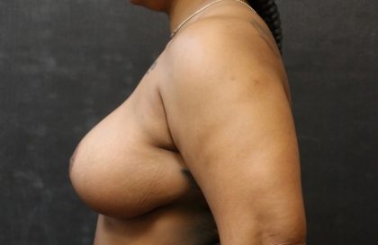 Breast Revision Before & After Patient #12248