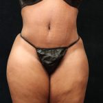 Revision Body Contouring Before & After Patient #12288