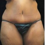 Revision Body Contouring Before & After Patient #12292