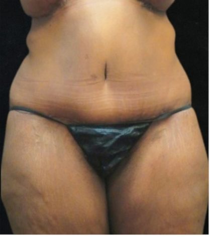 Revision Body Contouring Before & After Patient #12292