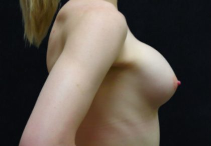 Breast Revision Before & After Patient #12249