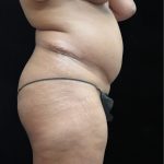 Revision Body Contouring Before & After Patient #12290