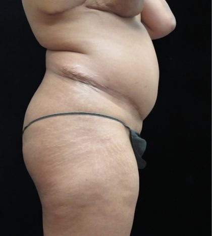 Revision Body Contouring Before & After Patient #12290