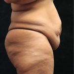 Revision Body Contouring Before & After Patient #12292
