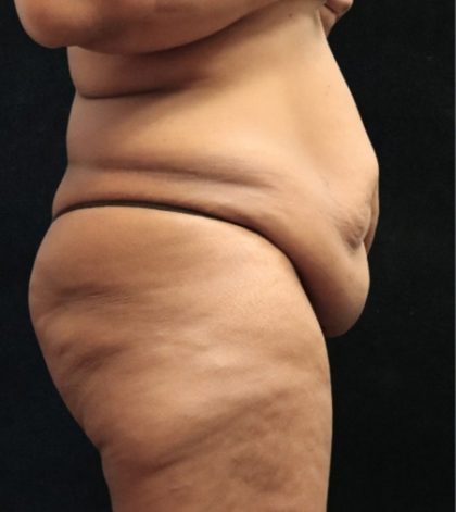 Revision Body Contouring Before & After Patient #12292