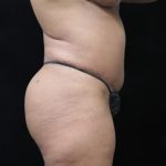 Revision Body Contouring Before & After Patient #12290