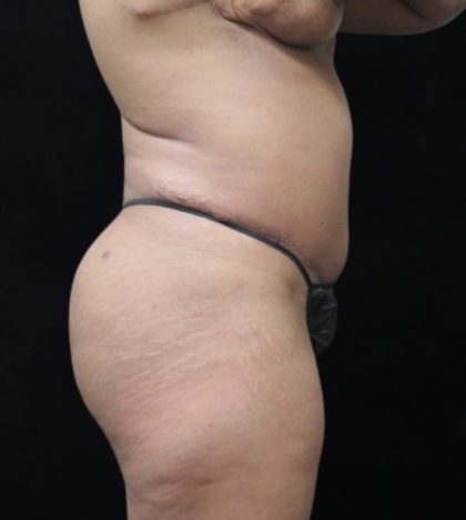 Revision Body Contouring Before & After Patient #12290