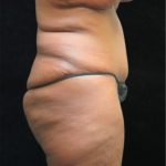 Revision Body Contouring Before & After Patient #12292