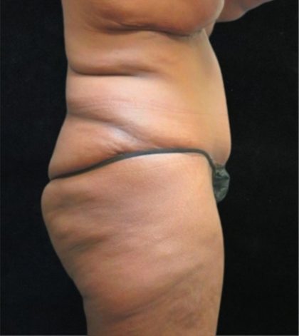 Revision Body Contouring Before & After Patient #12292