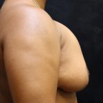 Breast Revision Before & After Patient #12248