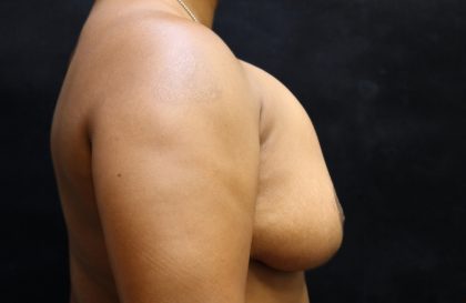 Breast Revision Before & After Patient #12248