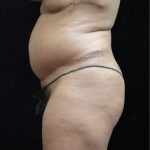 Revision Body Contouring Before & After Patient #12290