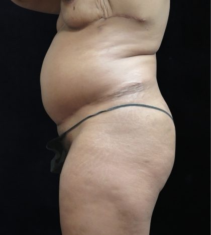 Revision Body Contouring Before & After Patient #12290