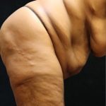 Revision Body Contouring Before & After Patient #12292