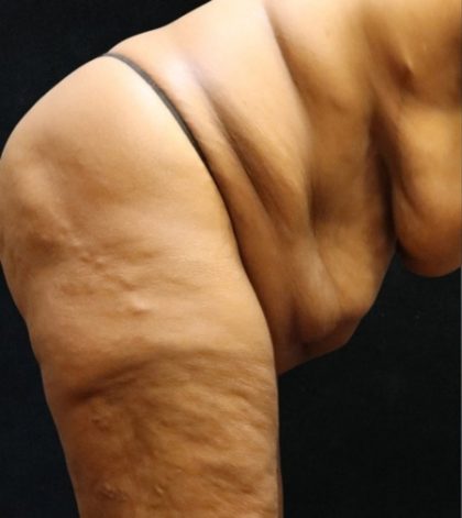 Revision Body Contouring Before & After Patient #12292