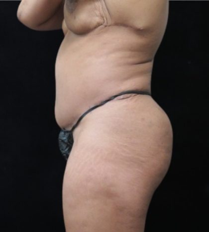 Revision Body Contouring Before & After Patient #12290