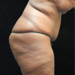 Revision Body Contouring Before & After Patient #12292