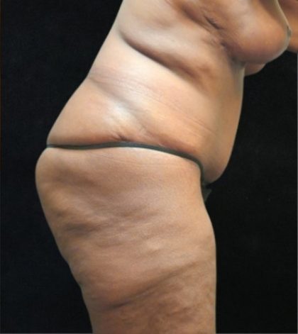 Revision Body Contouring Before & After Patient #12292