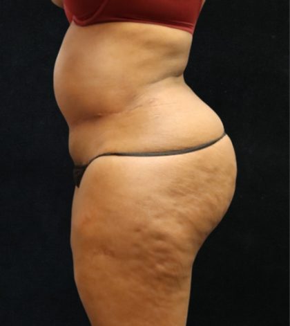 Revision Body Contouring Before & After Patient #12288
