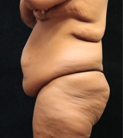 Revision Body Contouring Before & After Patient #12292