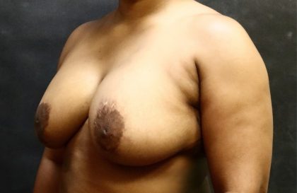 Breast Revision Before & After Patient #12248
