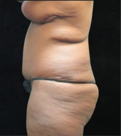 Revision Body Contouring Before & After Patient #12292