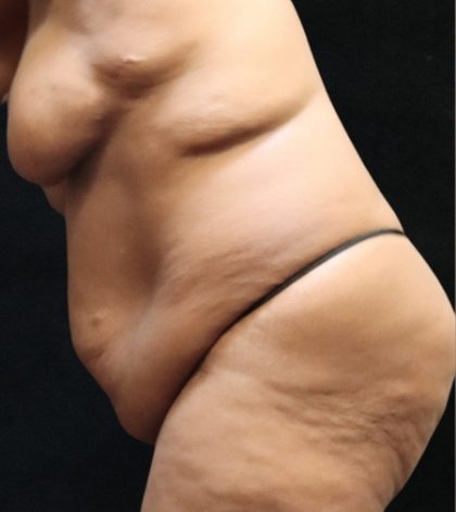 Revision Body Contouring Before & After Patient #12292