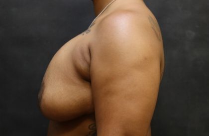 Breast Revision Before & After Patient #12248