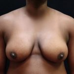 Transgender/Top Surgery Before & After Patient #12207