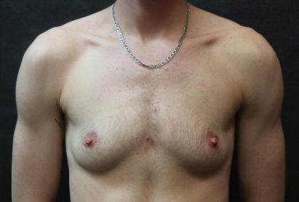 Transgender/Top Surgery Before & After Patient #12206