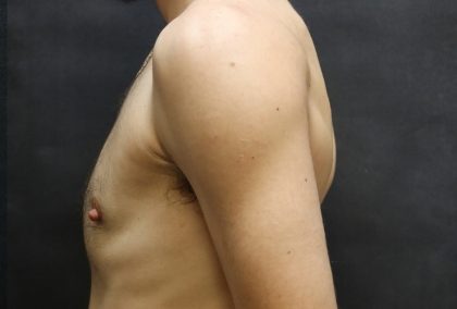 Transgender/Top Surgery Before & After Patient #12206