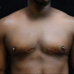 Transgender/Top Surgery Before & After Patient #12207