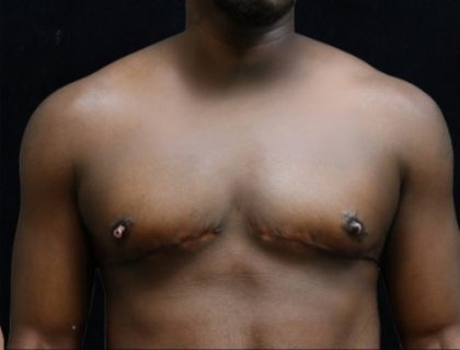 Transgender/Top Surgery Before & After Patient #12207