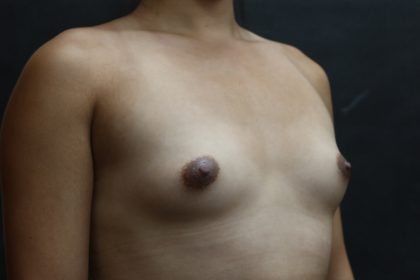 Transgender/Top Surgery Before & After Patient #12208
